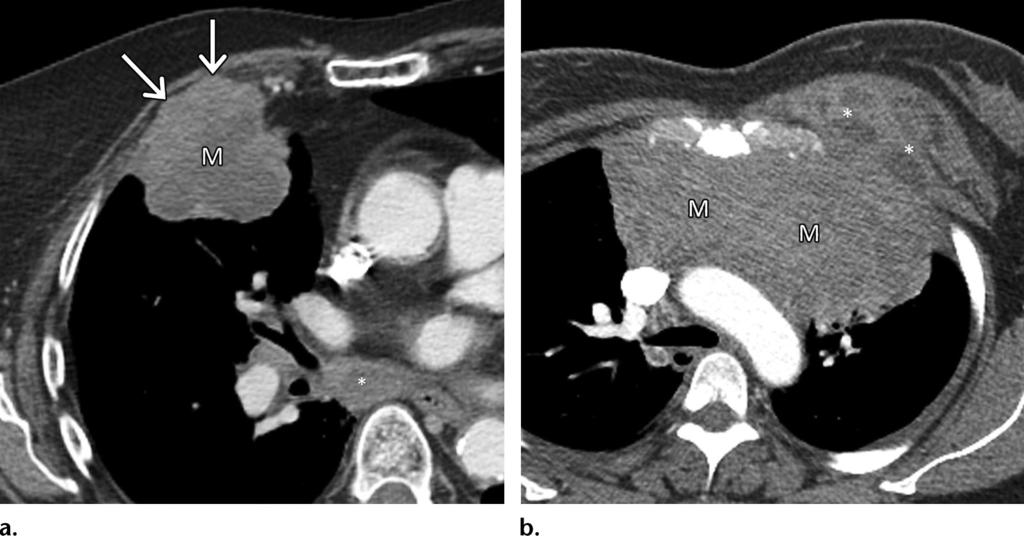 1302 September-October 2016 radiographics.rsna.org Figure 14. Secondary malignancies of the chest wall seen on axial contrast-enhanced multidetector CT images.