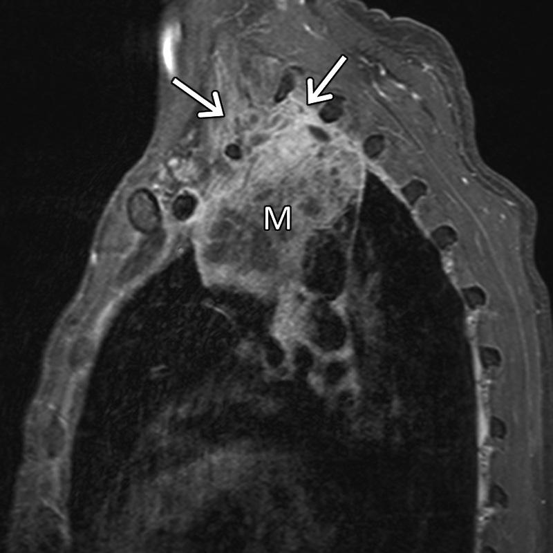 anterior chest wall (arrows), consistent with invasion. Note the enlarged subcarinal lymph node (*) consistent with nodal metastatic disease.