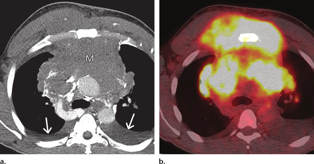 RG Volume 36 Number 5 Carter et al 1303 Figure 16. Hodgkin lymphoma of the mediastinum and chest wall in a 38-year-old man who presented with progressive chest pain and shortness of breath.
