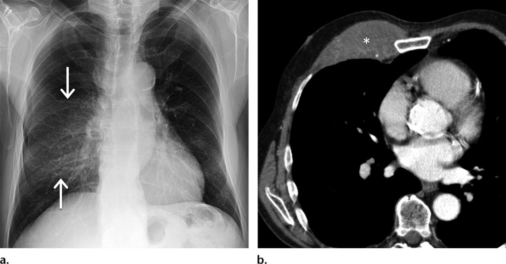 1288 September-October 2016 radiographics.rsna.org Figure 1. Non-Hodgkin lymphoma of the chest wall in a 58-year-old man who presented with right-sided chest pain.