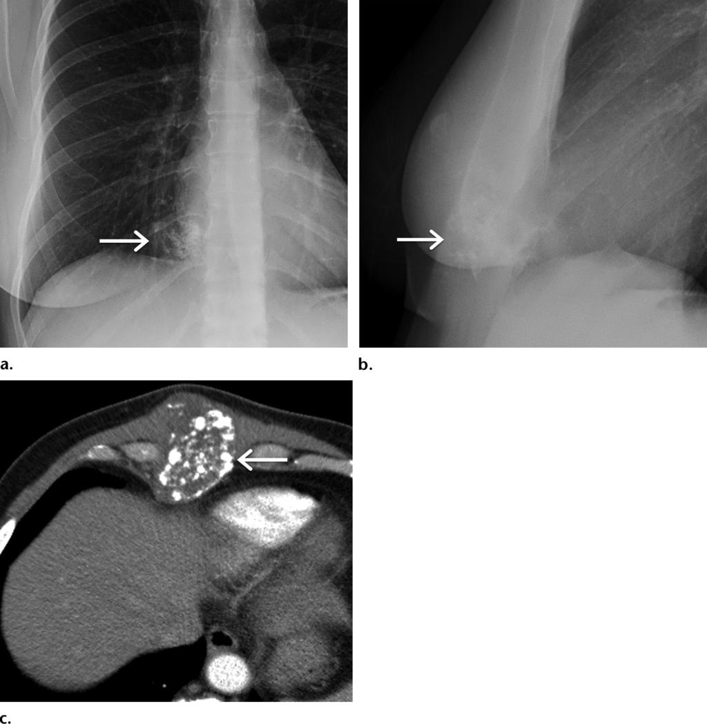 RG Volume 36 Number 5 Carter et al 1293 Figure 4. Chondrosarcoma of the chest wall in a 29-year-old woman who presented with focal right anterior chest pain.