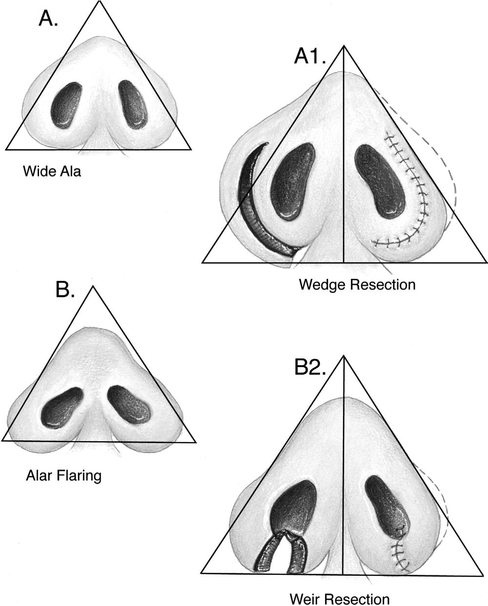 240 Operative Techniques in Otolaryngology, Vol 18, No 3, September 2007 Figure 8 Addressing the base: (A) Wedge resection; (B) Weir resection.