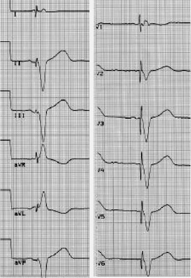 intraventricular, and
