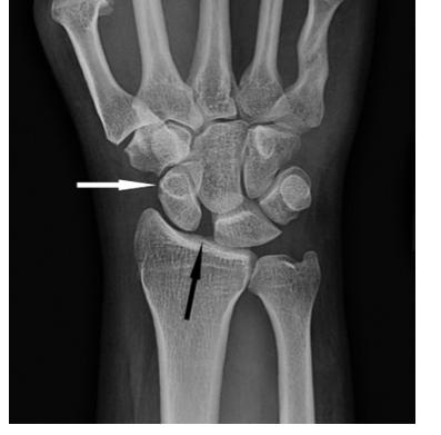 Figure 51-21 So stress views (clenched fist in ulnar deviation) may show pathologic > 3 mm scapholunate gap Stage 2: Perilunate