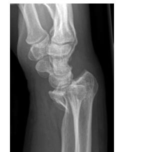 Radial shortening or +ve ulnar variance > 2mm Inadequate reduction is common in cases of: intra-articular fragments, radial inclination <15 deg, Immediate ortho referral for: Unsuccessful closed