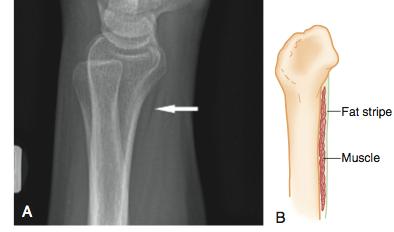 Galeazzi s 1. A fracture dislocation: the # d distal ⅓ of the radius, with a dislocation of the DRUJ 2.