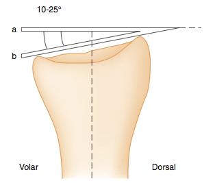 c. Volar Tilt The distal radius on a lateral view X-ray should have 10-25 degrees of volar tilt. Figure 51-6 1.