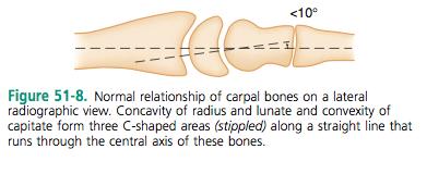 the 3rd metacarpal b) Forming three C-shapes, and the convexity of the distal capitate < 10 degrees c) See [fig