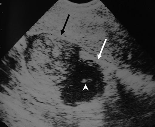 MRI in Fallopian Tube Carcinoma Discussion Primary fallopian tube carcinoma is uncommon and represents approximately 0.3% of all cases of gynecologic malignancy.