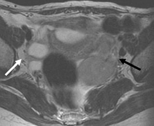 1 51-year-old woman with bilateral primary fallopian tube carcinoma. A, Transabdominal sonogram shows 3-cm solid mass (black arrow) associated with 2.
