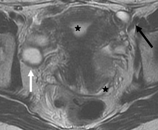 A fallopian tube affected by carcinoma may have no alteration in shape or size, or it may feature diffuse swelling; a sausage shape resembling hydro-, hemato-, or pyosalpinx; an unbuttoning pattern