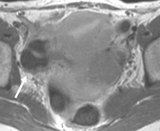 MRI in Fallopian Tube Carcinoma The sequential MR findings in our patient s case were considered characteristic of primary tubal carcinoma.