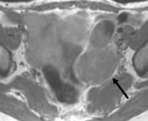 The left tubal tumor was seen as a sausagelike solid mass on initial MRI but was seen as an intratubal tumor with hydrosalpinx on the follow-up image.