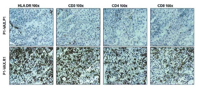 Representative staining for T cells in regressing and progressing metastases from same melanoma patient.