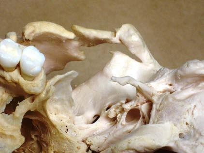 The styloid process of the left temporal bone is also broken and healed. (See Figure 7.) (The right is absent.) The styloid process is important to the function of the tongue and neck.