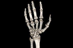 Metacarpal Metaphysis, Comminuted Frx of Base and Proximal Shaft of 5th Metacarpal