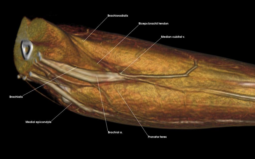 5: Anterior Forearm Describe the boundaries and contents of the cubital fossa Name the muscles that comprise the three layers of the forearm and