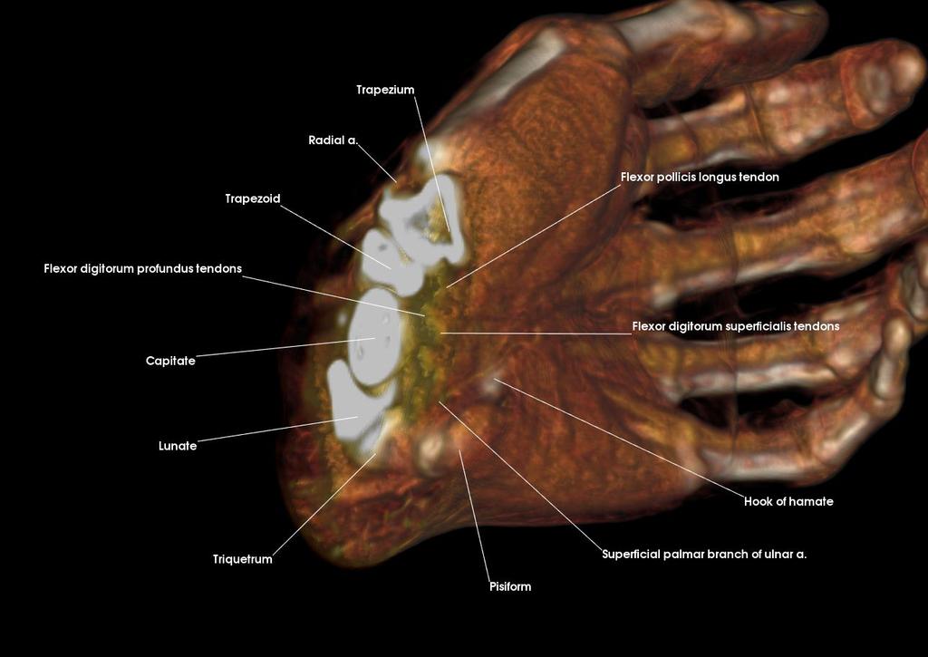 Carpal Tunnel Contents (Axial-cut Low-visibility) Capitate Flexor digitorum profundus tendons