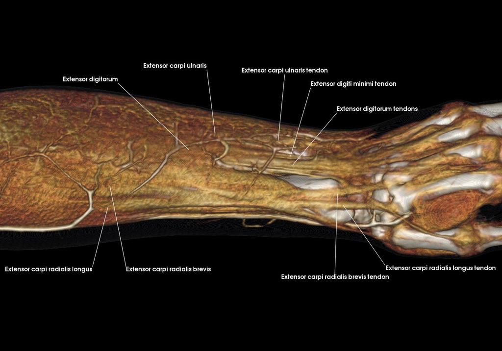 6: Posterior Forearm Review the muscles in the extensor group and describe their attachments and action Describe the anatomical snuffbox, including its boundaries