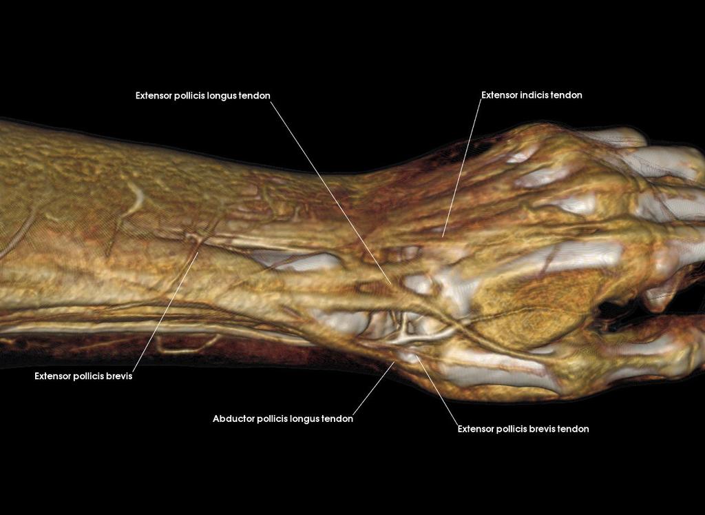 ulnaris Extensor carpi ulnaris tendon Extensor digiti minimi tendon Extensor digitorum Extensor digitorum tendons 6. a.