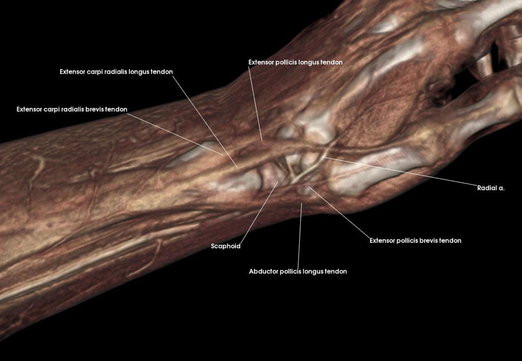 carpi radialis brevis tendon Extensor carpi radialis longus tendon Extensor
