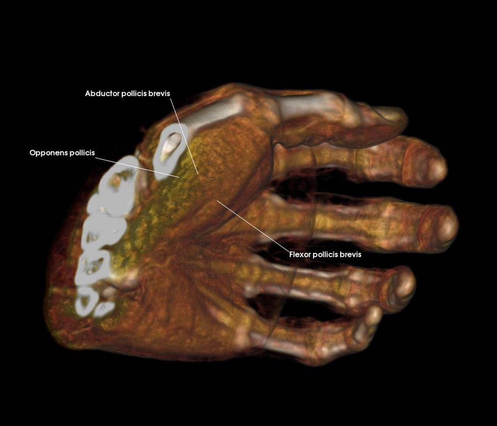 7: Hand Review the intrinsic muscles of the hand and discuss the actions of these muscles