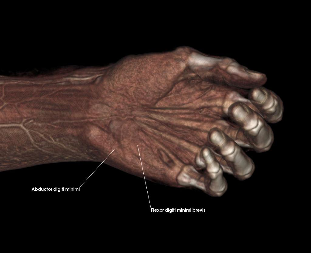 and the intrinsic muscles of the hand Abductor pollicis brevis Flexor pollicis brevis Opponens