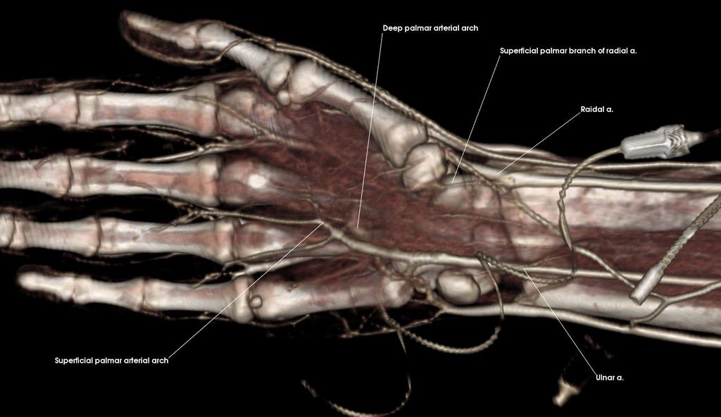 Arteries in the Forearm (Anteromedial) Deep palmar arterial arch