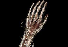 Superficial and Deep Palmar Arch Prominant Earlyfilling Veins Case 0155 Complex AV Formation Metacarpals