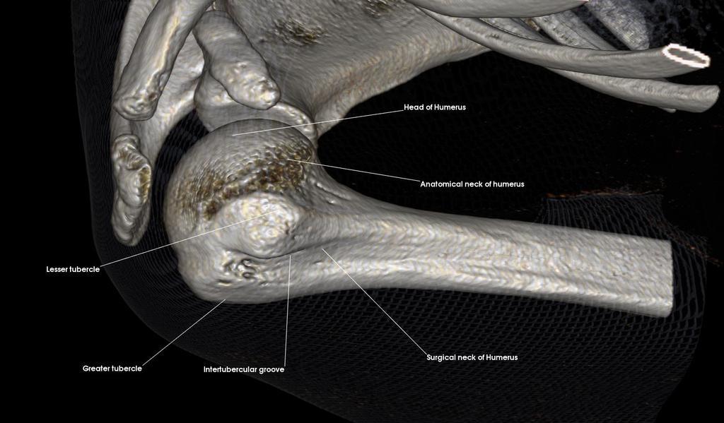 Anatomical neck of humerus Greater tubercle Head of humerus Intertubercular groove Lesser