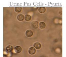 Urine Pus Cells - Pyuria Urine RBCs -