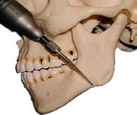 Make certain the osteotomy is made above or in front of the inferior alveolar nerve.