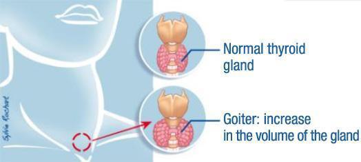 Goitre When the thyroid gland becomes enlarged this is called a goitre. It can affect one or both sides of the thyroid gland and usually grows slowly over time.