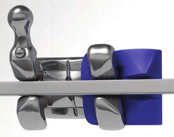 bracket positioning. The de-ligation saddles allow for easy removal of elastic ligatures.