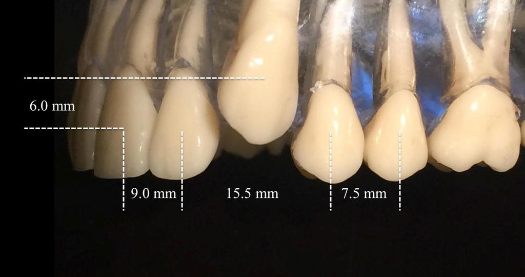 deflection was carried out gingivo-occlusally in the model to mimic intraoral conditions. Ten samples of each of the three 0.018 round superelastic wire types were deflected 6.1 mm across the 13.