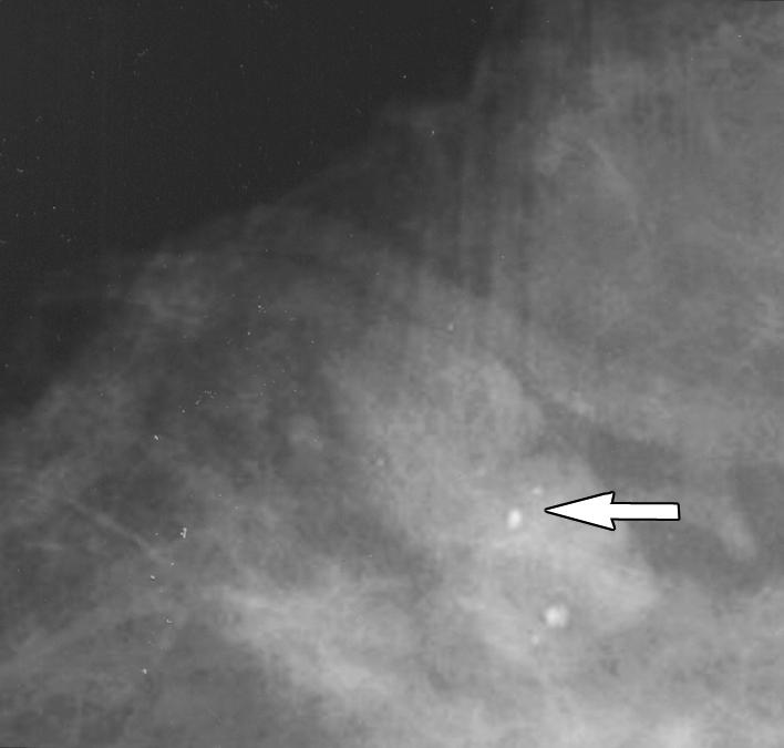 B, Sonogram of nodule shows multiple cysts without increased acoustic through-transmission. Calcifications (not shown) were evident within mass. sues.