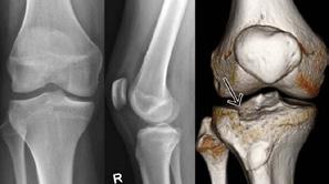 Materials and methods We have evaluated 64 patients with closed tibial plateau fractures surgically treated between January 2013 and decembre 2015 in the Orthopedic- Traumatology Clinic of Constanta,