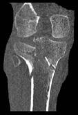 The radiologic evaluation of the late results was made by appreciation of posttraumatic arthrosis risk using Kellgren/Lawrence score.
