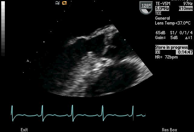 Moderate aortic regurgitation CASE PRESENTATION Normal