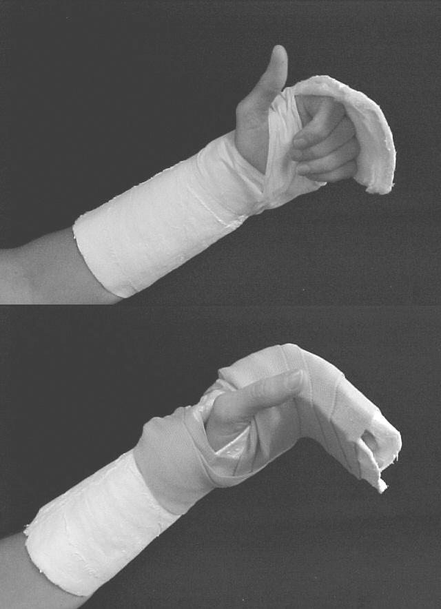 A B FIGURE 5. (A) Cast for multiple metacarpal fractures permitting early active finger flexion; (B) resting volar component added to maintain interphalangeal joints in full extension.