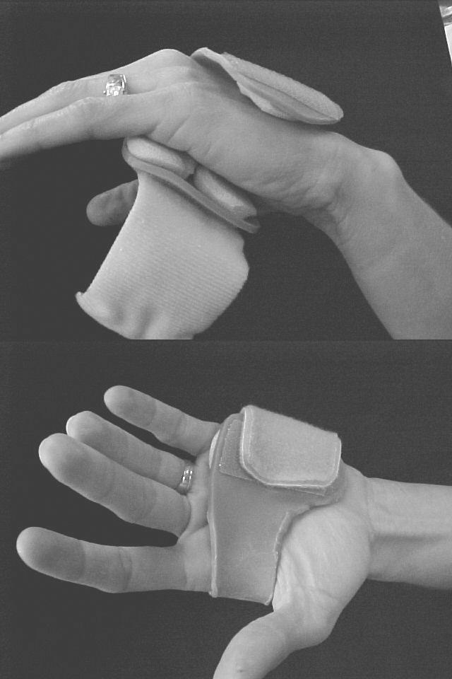 Metacarpal Shaft Fracture Shaft fractures are extra-articular fractures caused by fall, blow, or crushing force that usually angulate dorsally and may have components of shortening and/or rotation.