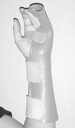 serial reduction of splint to permit motion as fracture healing occurs; (D) passive range of motion in splint.
