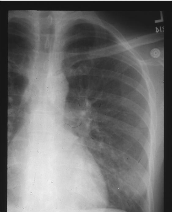 36 year old male with pulmonary tuberculosis, Hep C +, LFT elevated X 3 nl, Started on RIPE, tolerated treatment well What ART should we start?