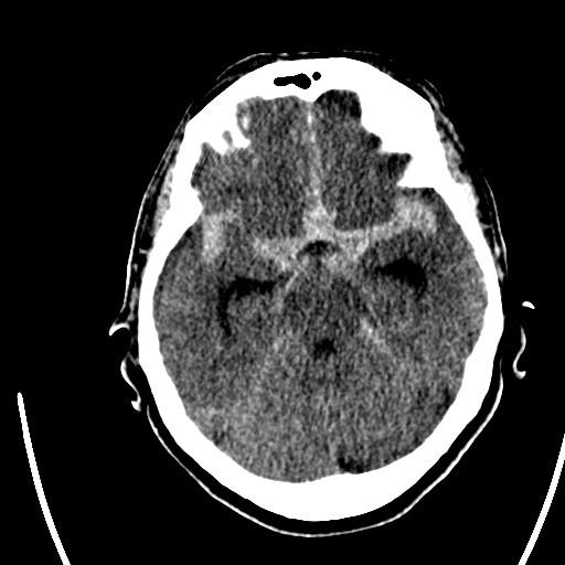 CT signs of SAH Hyperdensity in the subarachnoid spaces,
