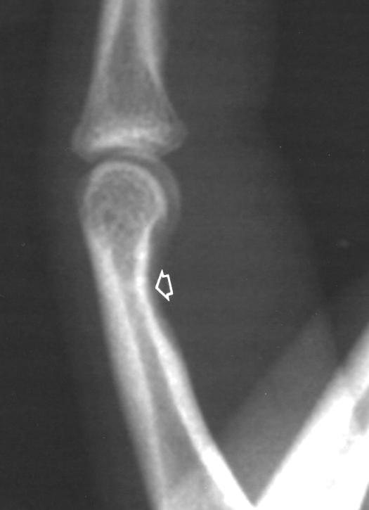 MR Imaging of the Tendon Sheath one patient had a history of recent trauma. ll tumors were in the upper extremities and associated with an adjacent tendon.