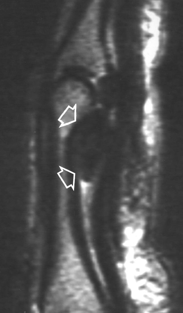 One of these heterogeneous lesions was homogeneous on T1weighted images. The remaining lesion was homogeneous on both T1- and T2-weighted images.