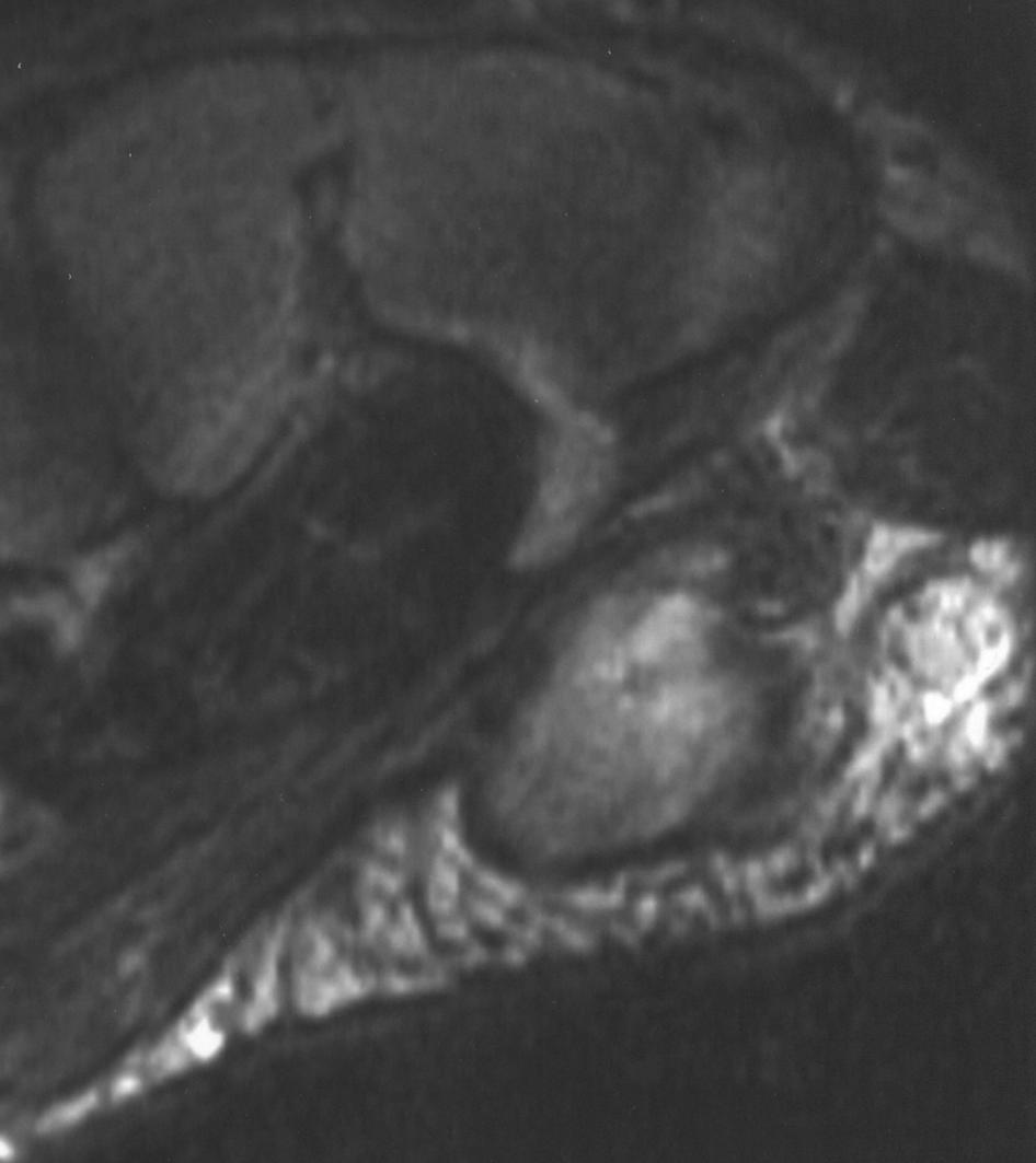 Fox et al. Fig. 3. 67-year-old woman with painless mass over palmar surface of left wrist.