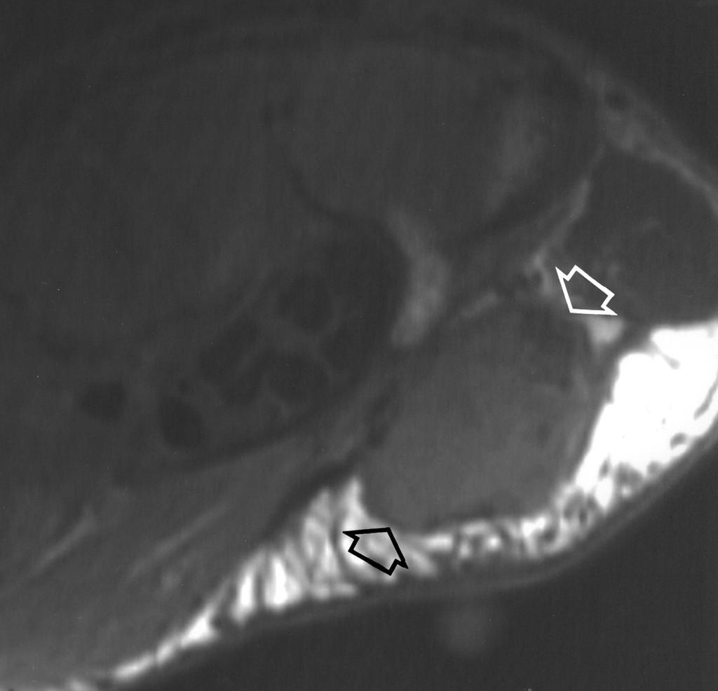 Five of the patients in our study had tumors that showed a signal intensity similar to or less than that of skeletal muscle on T1weighted spin-echo MR images (Fig.