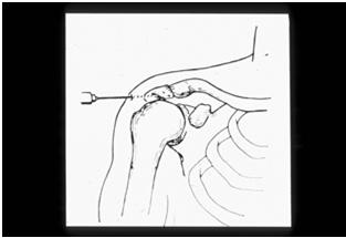 needle at Posterior soft spot Aim parallel to angle of lateral acromion to reach subacromial bursa Direct needle towards opposite nipple