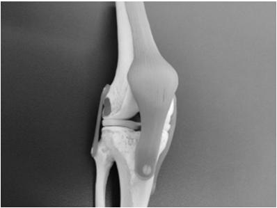 meniscus tear or OA - IT band syndrome - LCL sprain (rare) - Fibular head: fracture (rare) Medial - Medial joint-line: meniscus tear or